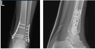 Left Ankle X-ray complete 3 or more views-4 week post operative