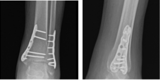 Left Ankle X-ray complete 3 or more views 16 weeks post operative