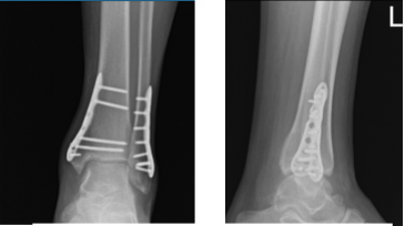 Left Ankle X-ray complete 3 or more views 8 weeks post operative