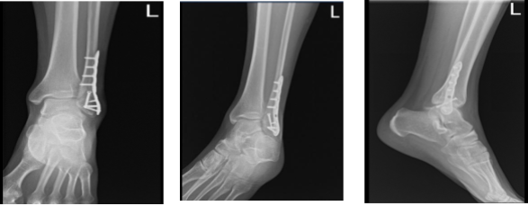 Left ankle X-ray complete 3 (2)