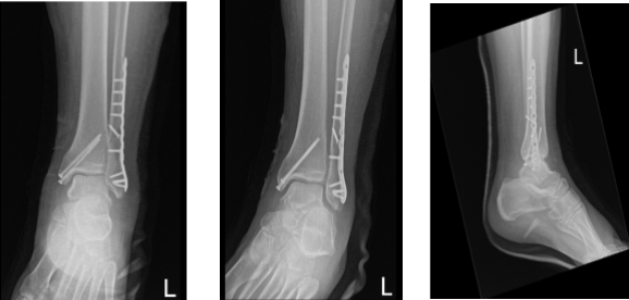 Left ankle X-ray complete 3 or more views 