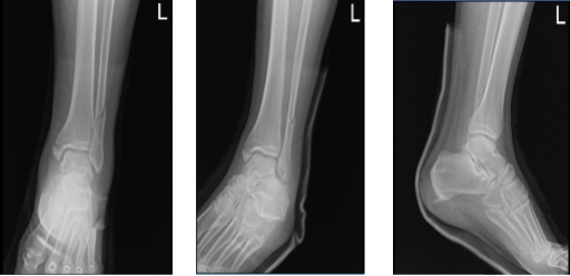 Left ankle X-ray complete 3 or more views