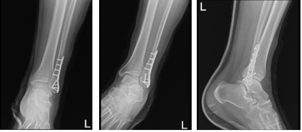 Left ankle X-ray complete 3