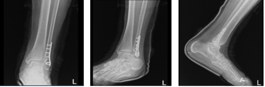 Left ankle x-ray complete