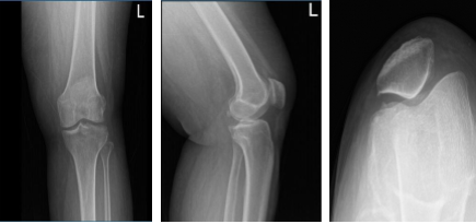 Left knee x-ray complete with patella