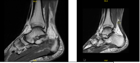 MRI-1.2T Left ankle non-contrast