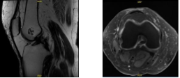MRI-3T Right knee non-contrast