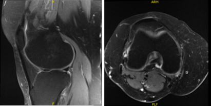 MRI-3T Knee non-contrast