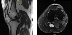 MRI-3T Left knee non-contrast