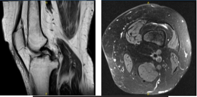 MRI-3T Left knee non-contrast