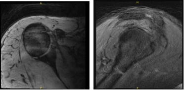 MRI-3T Right Shoulder non-contrast