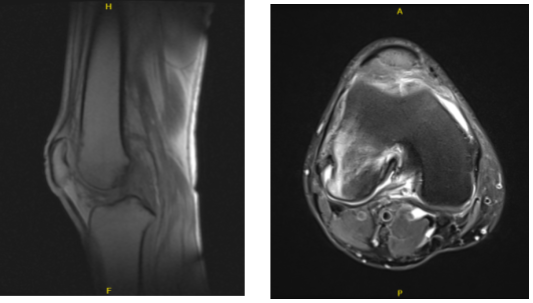 MRI-3T Right knee non-contrast