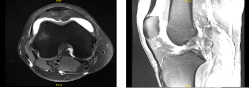 MRI-3T Right knee non-contrast