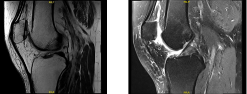 MRI-3T Right knee non-contrast