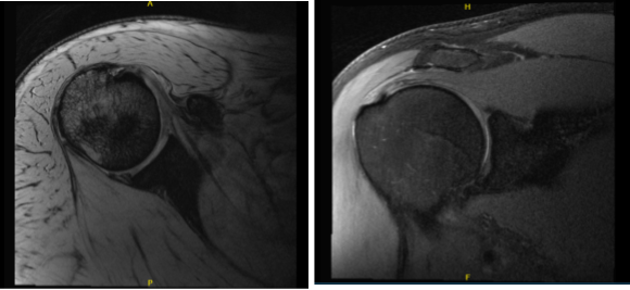 MRI-3T Right shoulder non-contrast