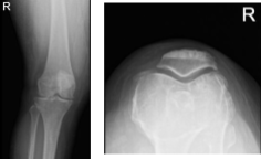 MRI-3T right knee non-contrast
