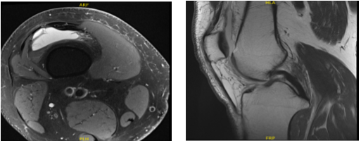 MRI-3T right knee non-contrast
