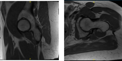 MRI Left hip non-contrast