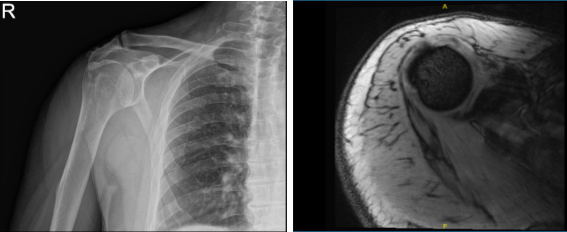 MRI X-ray of right shoulder