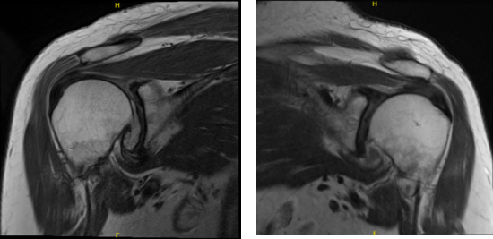 MRI of Left and Right Shoulder