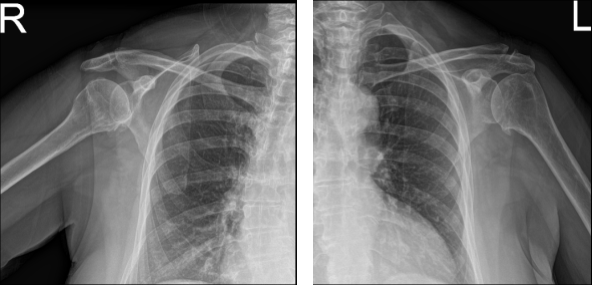 MRI of Left and Right Shoulder
