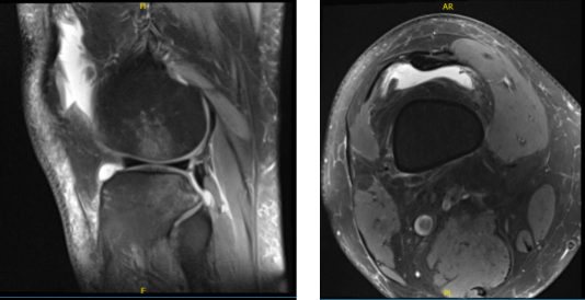 MRI of knee