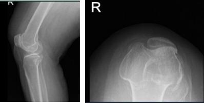MRI of right knee