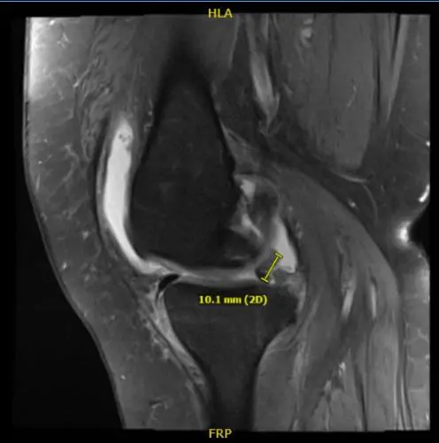 MRI of right knee