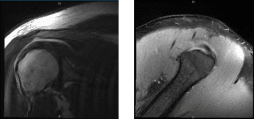 MRI of right shoulder