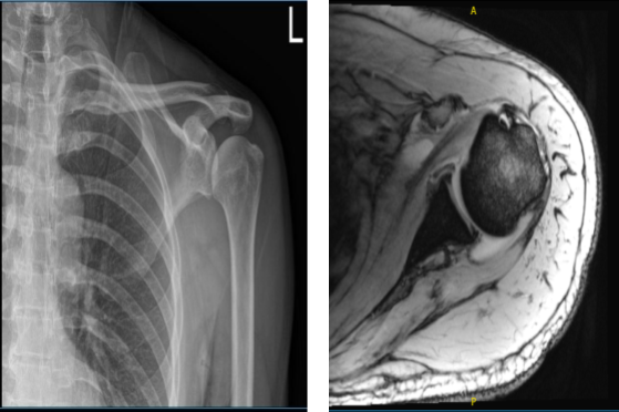 MRI of the left shoulder