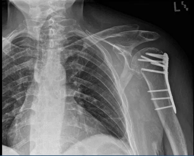 Post-operative X-ray