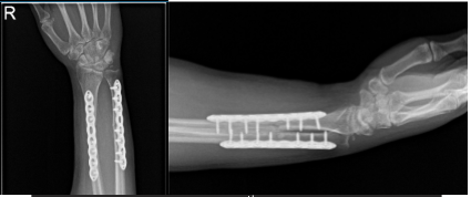 Right Forearm X-ray-16th week post-operative