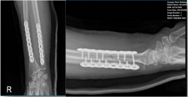 Right Forearm X-ray-1st week post-operative