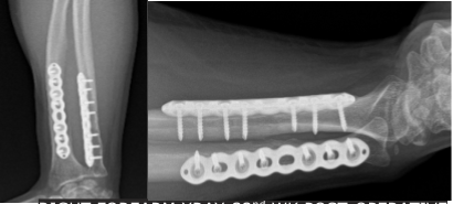 Right Forearm X-ray-32nd week post-operative