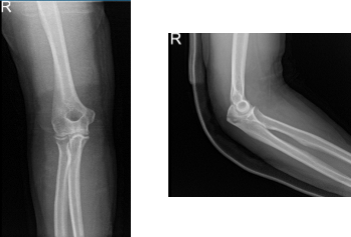 Right elbow x-ray