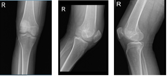 Right knee X-ray AP lateral and oblique 3 views