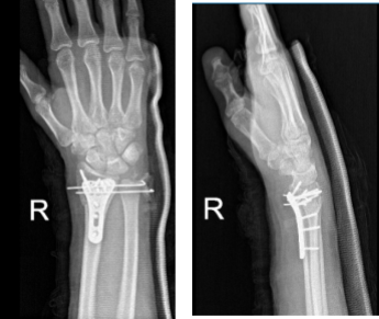 Right wrist X-ray 3 or more views-4th week post operative