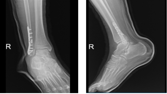 X-ray right ankle - 3 weeks after surgery
