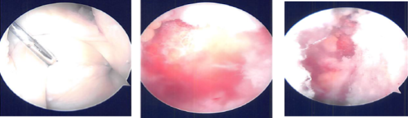 MRI of the right knee