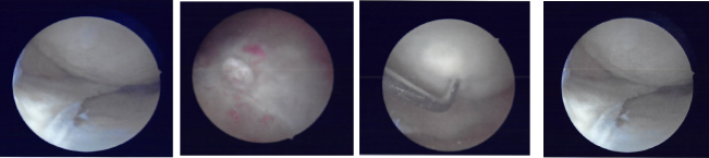 Intraoperative Arthroscopic Images