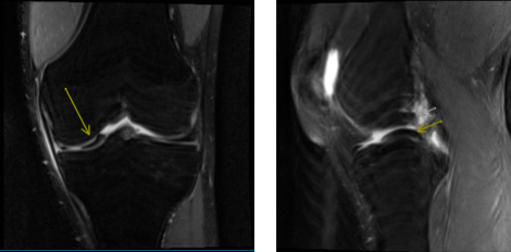 MRI of left knee
