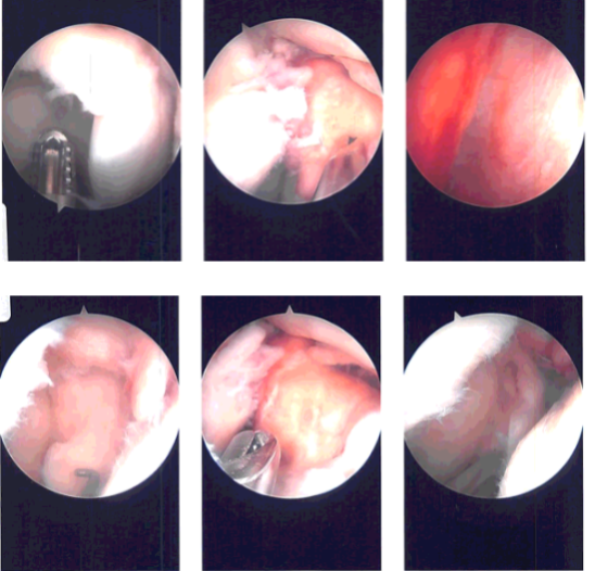 Intraoperative Arthroscopy Images