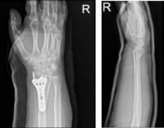 Right wrist x-ray 3 or more views