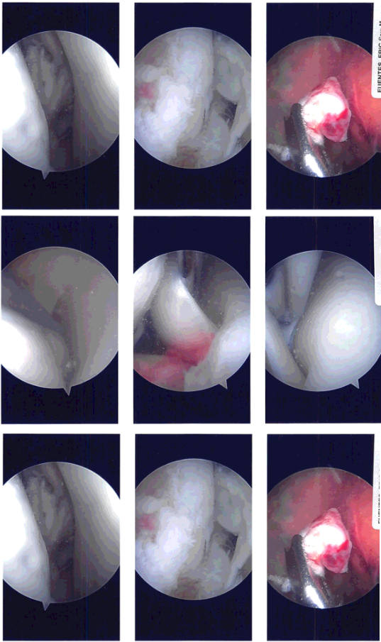 Intraoperative Arthroscopy Images