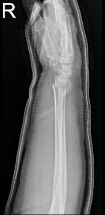 Right elbow x-ray