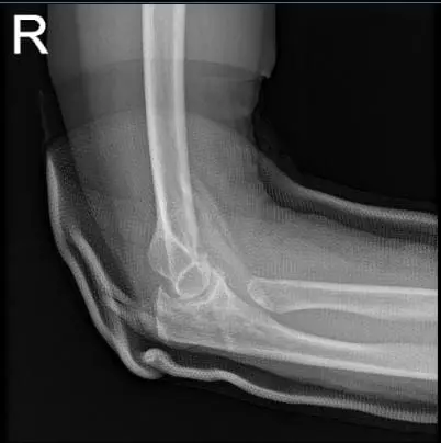 Doppler Venous Lower Extremity Bilateral
