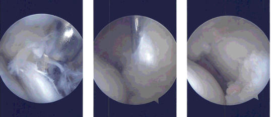 Intraoperative Arthroscopy Images