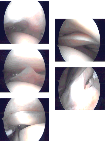 Intraoperative Arthroscopy Images