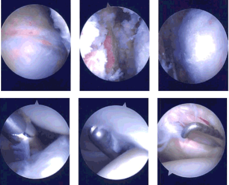 Intraoperative Arthroscopy Images