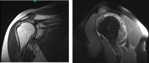 MRI right shoulder non-contrast